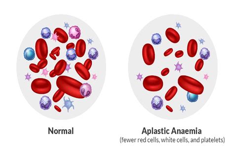 Aplastic Anemia .
